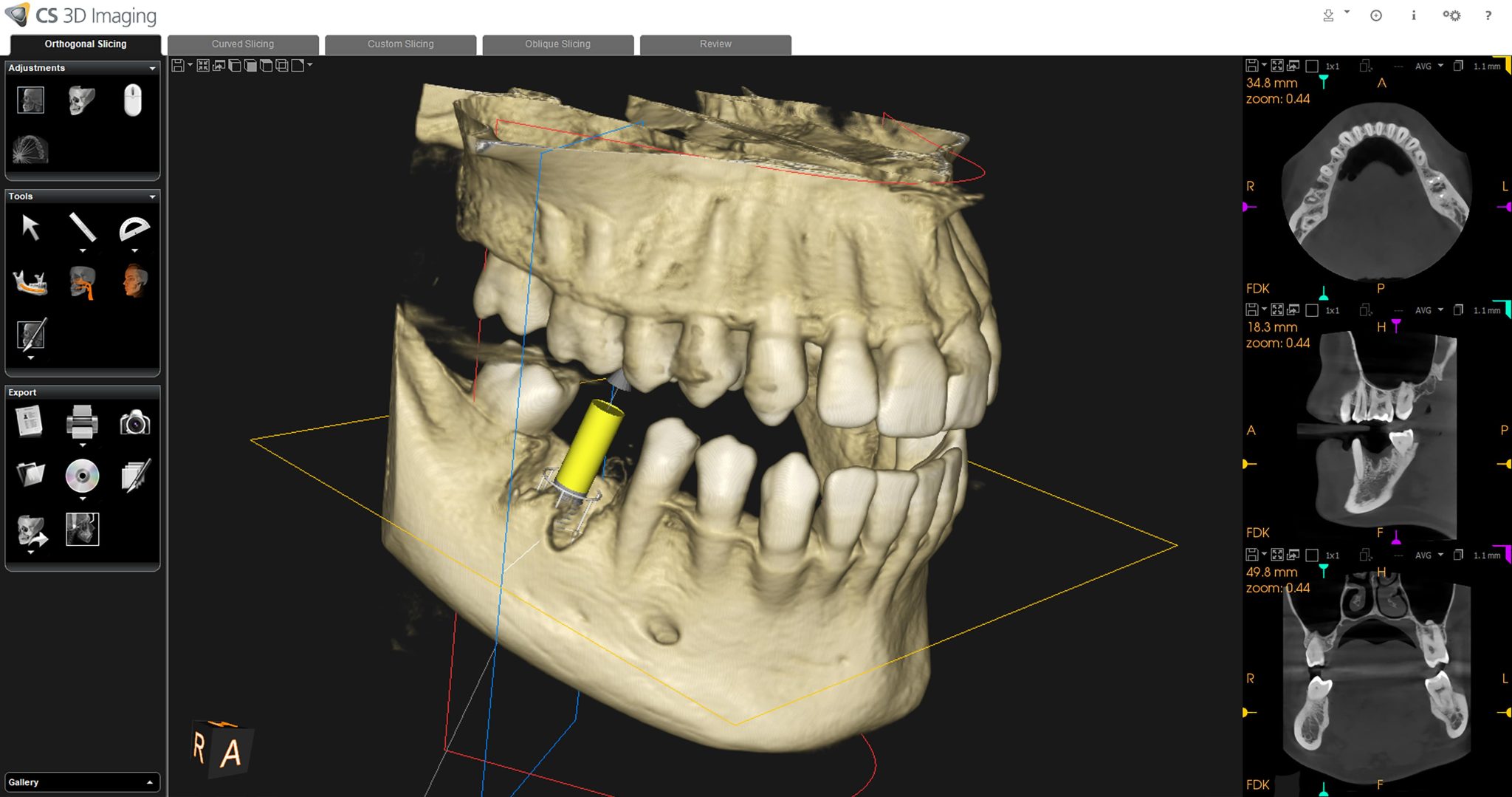 Applications Dental Cbct